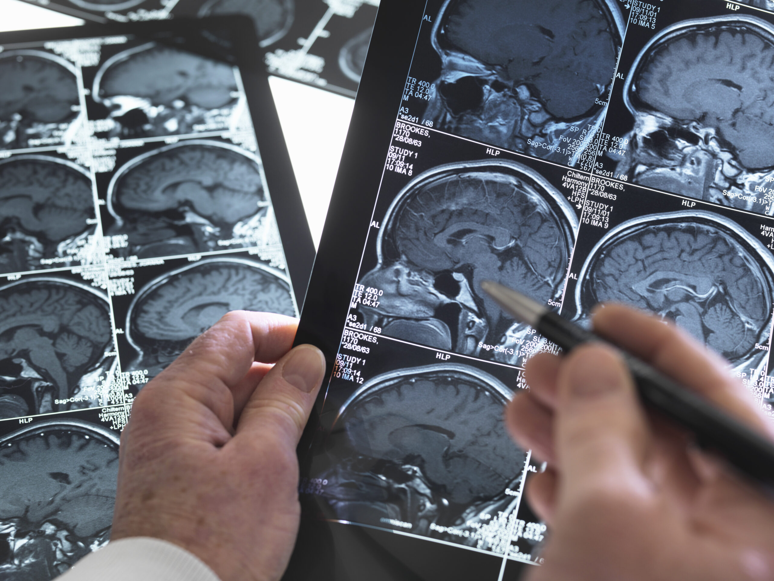 Close up of doctor viewing a healthy brain scan close up of doctor viewing a healthy brain scan 2025 04 03 15 38 52 utc scaled